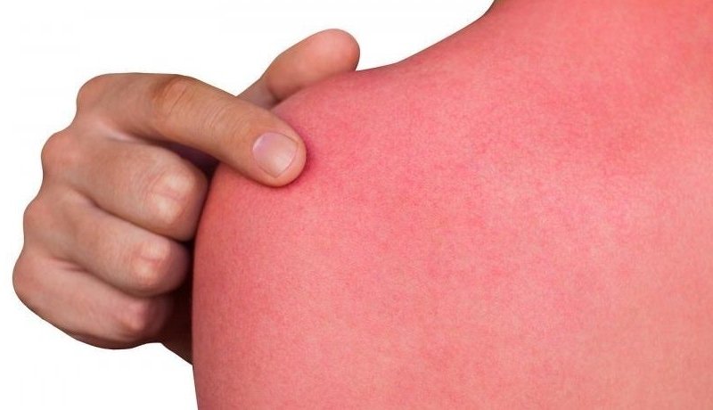 В Тбилиси солнце обожгло 180 человек