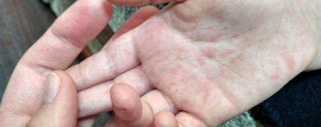 В Грузии опасаются эпидемии кори