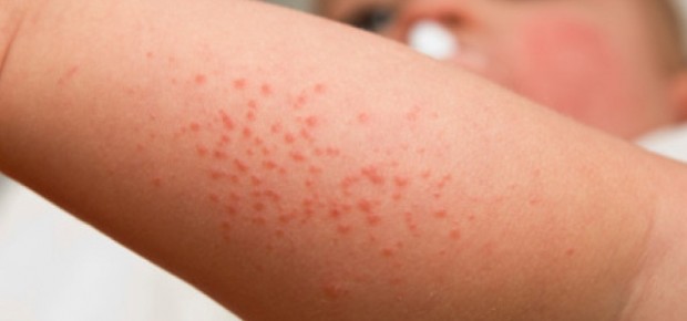 В Грузии зафиксированы 142 случая кори